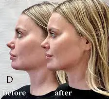 Facial Balancing