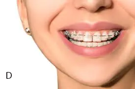 Gap teeth