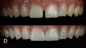 Gap teeth