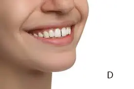 Gap teeth