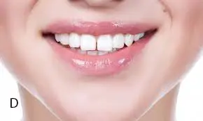 Gap teeth
